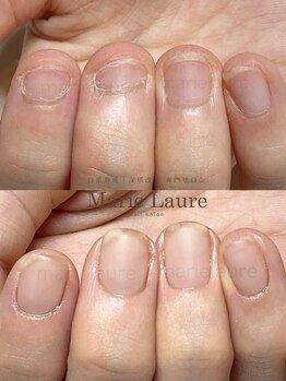 マリーロール 淀屋橋本店(Marie Laure)/自爪育成/深爪矯正/ネイルケア