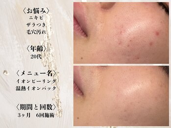 アクール(Accueil)/【ニキビ】