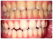 コントレール 歯ぁと(CONTRAIL)の雰囲気（25歳女性。毎週照射、１か月後です。）