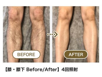 薫風 大阪豊中店/メンズ　脚脱毛