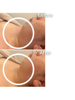 エムボーテ 太田店(M BEAUTE33)/顔筋小顔コルギ