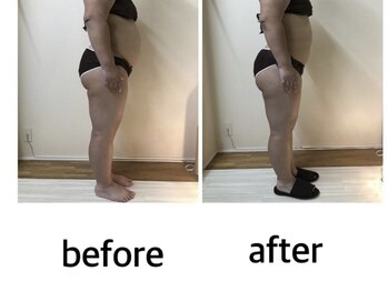 カーム(Calm)/脂肪冷却