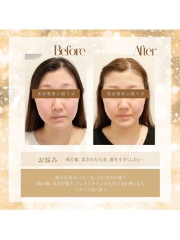 美容整骨小顔ラボ/ビフォーアフター