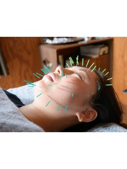 鍼灸施術を受けたい