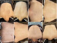 ヒジ(Life Salon)の雰囲気（背中ハーブピーリング◎Before /After）