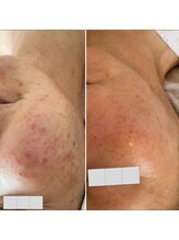 リュミエール(Lumie're)/赤みケア