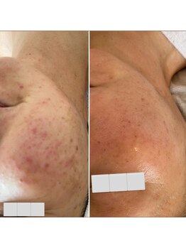 リュミエール(Lumie're)/赤みケア