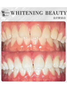 ホワイトニングビューティー 金沢駅前店(WHITENING BEAUTY)/初回でも効果を実感できる!