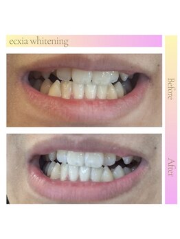 エクシアホワイトニング 天王寺店/ホワイトニングビフォーアフター