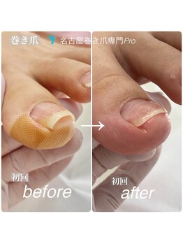 巻き爪補正初回の変化