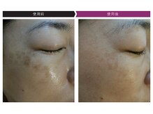 パーフェクトフェイスビューティー 梅田店(PERFECT FACE BEAUTY)/ディレイアコスメ（1種）使用