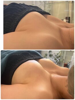 エムプリュ 心斎橋店(M.plus)/美乳コース3回目→8回目＋光豊胸