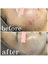 オーシャンブルー 長崎店(OCEAN BLUE)/ダイヤモンドピーリング症例