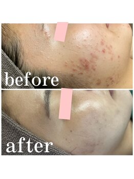 オーシャンブルー 長崎店(OCEAN BLUE)/ダイヤモンドピーリング症例