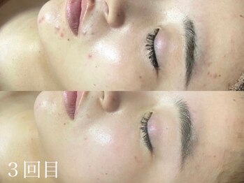 ホワイトアクア 岐阜店(WHITE AQUA)/ハーブピーリング/岐阜/ニキビ