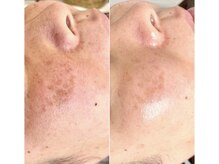 ベルファム(Belle femme)/エクソソームハーブピーリング