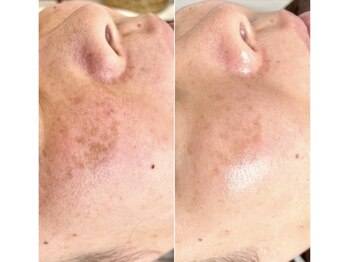 ベルファム(Belle femme)/エクソソームハーブピーリング