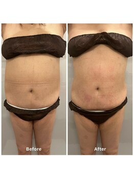 ルミナス/CAVI -CRYO PRO の凄さ！