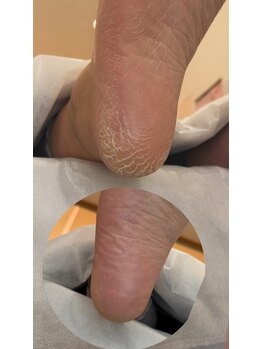 フットミー(foot mii)/１回目Before・After