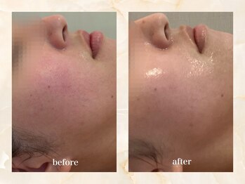 セーラマーレ(cera-mare Esthetic by CARDIA)/ララピール　施術1回