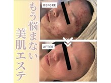 プラス ケア(Plus Care)の雰囲気（毛穴レス◇毛穴洗浄&ピーリングで気になる毛穴のひらき/黒ずみに）