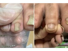 ユマニ バイ ヒート(Humani by HEAT)/巻いた爪のケア補正¥5500～