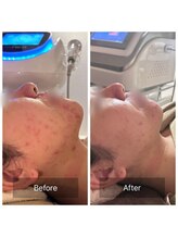 ラ ブリエ(La Briller)/プラズマ炭酸パック3回目×小顔