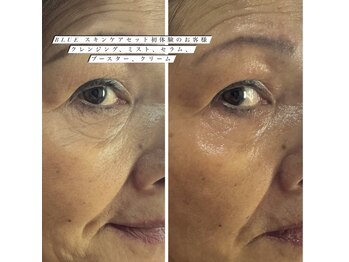 クイーン ビューティーサロン 大久保本店(Queen Beauty Salon)/話題の塗る針で肌質改善