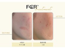 ハーバル 新宿店(HERBAL)/最強★韓国FCRハーブピーリング