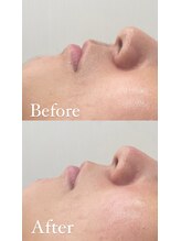 ラクシー 船橋(luxssy)/お顔シェービング