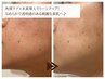 【シミ改善】瞬間透明肌！水素×角質ケア×毛穴洗浄　80分　￥19800→￥16500