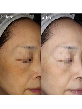 リアルナ(REALUNA)の写真/年々増えていくシミ・小じわ正をしいアプローチで改善◎これ以上増やさないケアのご提案も！
