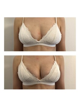 ミント(M’int)/バスト下垂が気になる方