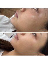 ホワイトワックス 難波店(WHITE WAX)/ワントーン明るい肌へ