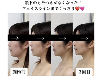 フェミニー(Feminy)/【小顔整顔リフト】たるみケア