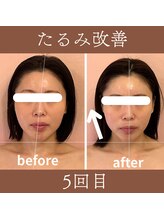 カムズ ビューティー(COMES BEAUTY)/たるみ改善エステ5回目