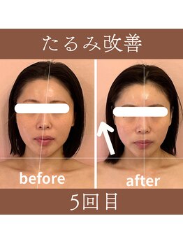 カムズ ビューティー(COMES BEAUTY)/たるみ改善エステ5回目
