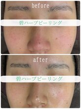 キラ肌 出雲店/剥離なし☆肌質改善！
