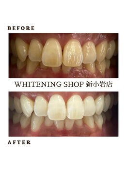 ホワイトニングショップ 新小岩店/歯科提携 ホワイトニング専門店