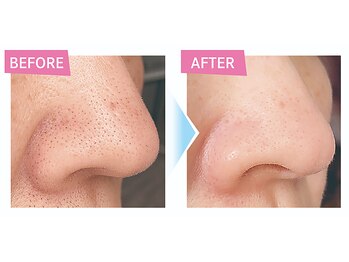 レクラ バイ ドクターエイチ(L'ECLAT by Doctor.H)/ハイドロ毛穴洗浄