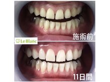 ルブラン 奈良店(Le Blanc)/確実に着色汚れ落とせます