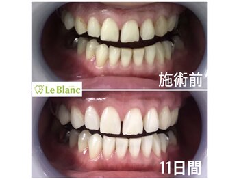 ルブラン 奈良店(Le Blanc)/確実に着色汚れ落とせます