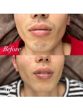 ボス 大曽根店(BOSS)/ヒゲ剃り＆カミソリ負け卒業！！