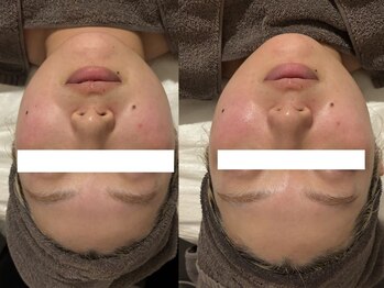 シェリー(CHERIE)/小顔リフトアップコース