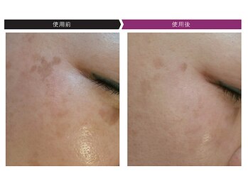 パーフェクトフェイスビューティー 梅田店(PERFECT FACE BEAUTY)/ディレイアコスメ（1種）使用