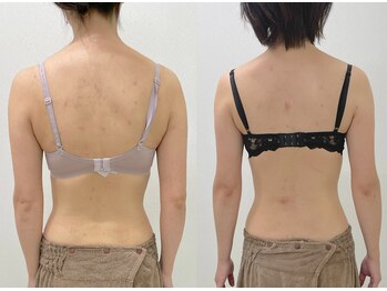 ワイサロン(Y salon)/40代/産後バストアップ/4ヶ月