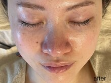 サロン ド エメ(salon de aimer)/【After】毛穴縮小 透明感アップ