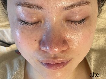 サロン ド エメ(salon de aimer)/【After】毛穴縮小 透明感アップ