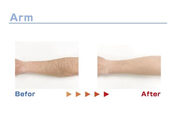 キングスサロン 熊本/腕脱毛