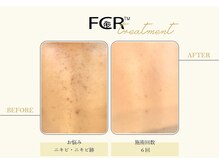 ハーバル 新宿店(HERBAL)/最強★韓国FCRハーブピーリング